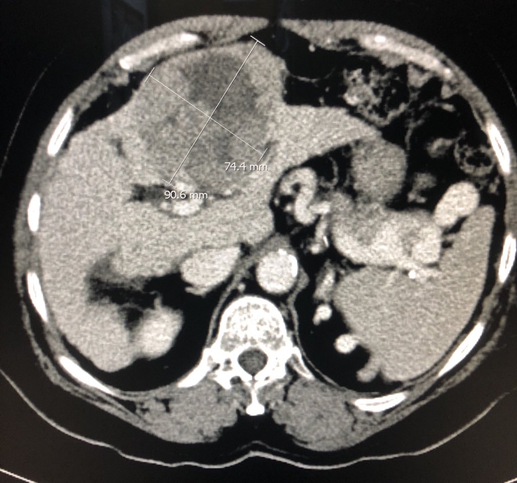 ibrahim_Gh's tweet photo. Satisfying response of #DEBTACE #IRad treating #HCC #MIIB #IO #withoutascalpel https://t.co/gROLo4pcLq