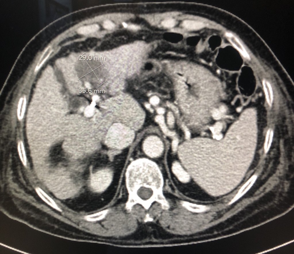 ibrahim_Gh's tweet photo. Satisfying response of #DEBTACE #IRad treating #HCC #MIIB #IO #withoutascalpel https://t.co/gROLo4pcLq