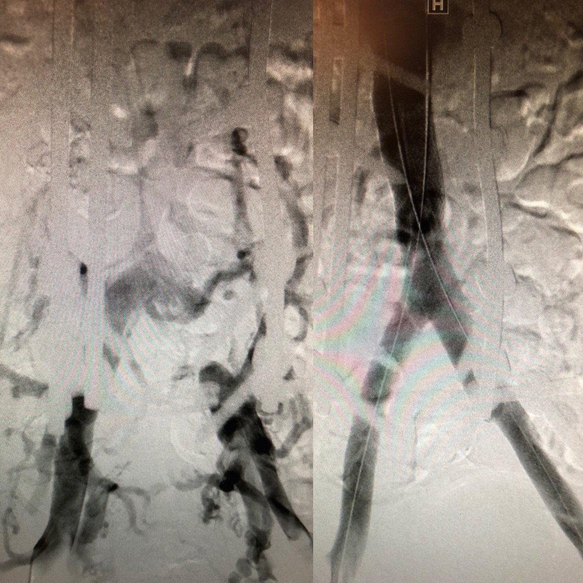 kush_r_desai's tweet photo. Iliocaval occlusion 2/2 IVCF; #filterOUT was the easy part, but had to โrendezvousโ to get through flush occlusion of L iliac. Learn #WeCanRecan tips/tricks and get more VTE goodness @SIRspecialists #ACTiVE18, next week in Chi-Town! Register here https://t.co/hdJGRoH9Is https://t.co/pL0C6a1XyG