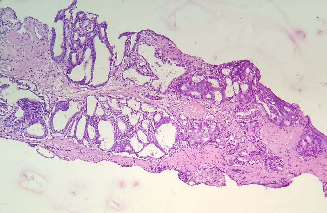 DrNishatAfroz2's tweet photo. Male 5th decade, CNB prostate.HG-PIN- cribriform adjacent to acinar Aca ! P63 staining patchy n discontinuous.
#Pathology #Histopathology #GUPath #HumanPathology https://t.co/jXkcS7vk9K