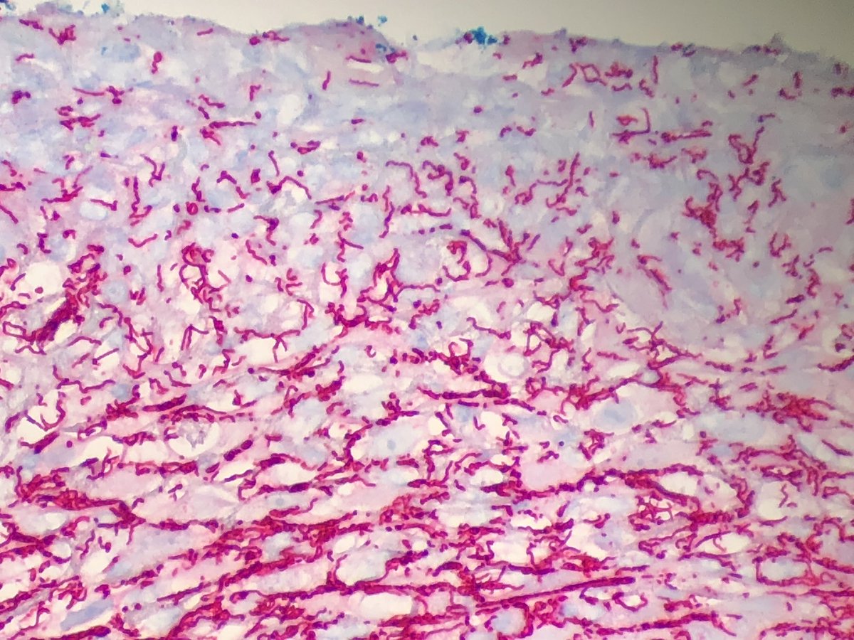 Anal condyloma icd 9 Anal condyloma icd 9