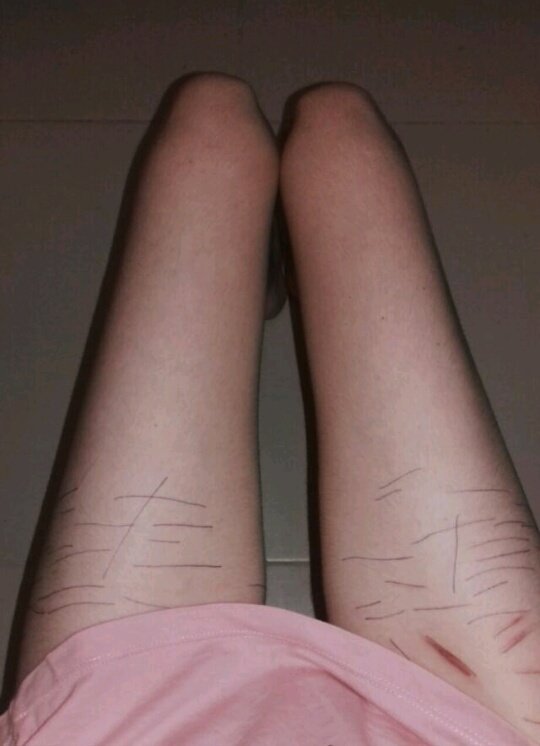 anasecretss's tweet image. contornei minhas cicatrizes das coxas com caneta... quero fazer isso de novo ano que vem e não ter mais marcas que isso (#bodycheck #edproblems)