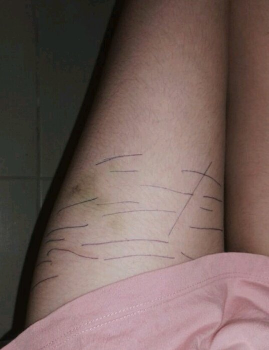 anasecretss's tweet image. contornei minhas cicatrizes das coxas com caneta... quero fazer isso de novo ano que vem e não ter mais marcas que isso (#bodycheck #edproblems)