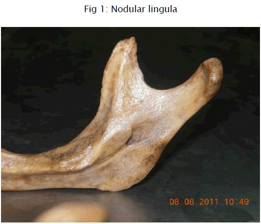 MednHealScience's tweet photo. Morphological Variations of #Lingula in South Indian #Mandibles
https://t.co/z4iMMTFku7 https://t.co/6feTzzzGvT
