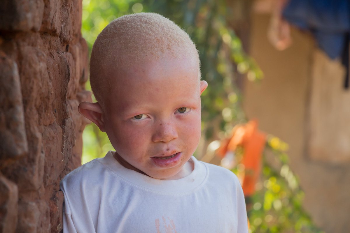 Kmg_uganda's tweet image. It has been a pleasure working with you in the effort to sound the voices of people with albinism in Uganda and world over . people with albinism are people like us. End the stigma . thanks @OgikPeter @SNUPA6 @Kmg_uganda