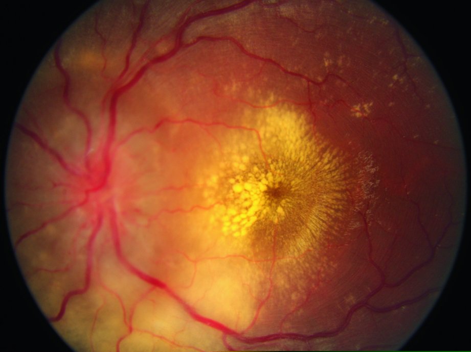 Ангиопатия сосудов головного. Ретинопатия глазное дно. Гипертоническая ретинопатия глазное дно. Ангиоспастическая ретинопатия. Гипертоническая ретинопатия офтальмоскопия.