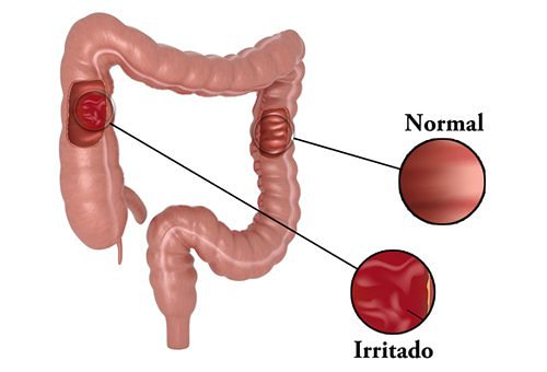GoodServiceT's tweet image. Sindrome del colon irritable dolencia que padecen muchas personas. #teayudamos