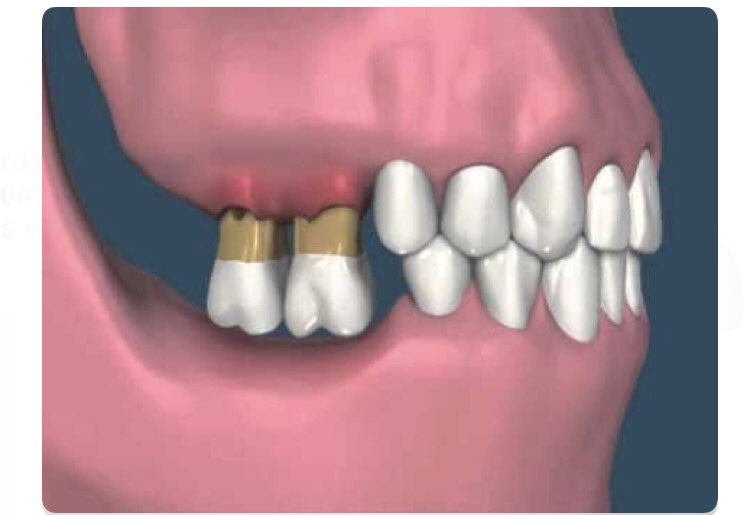 Dentagama's tweet photo. Teeth overeruption due to missing opposing molars https://t.co/z7dexs44QL