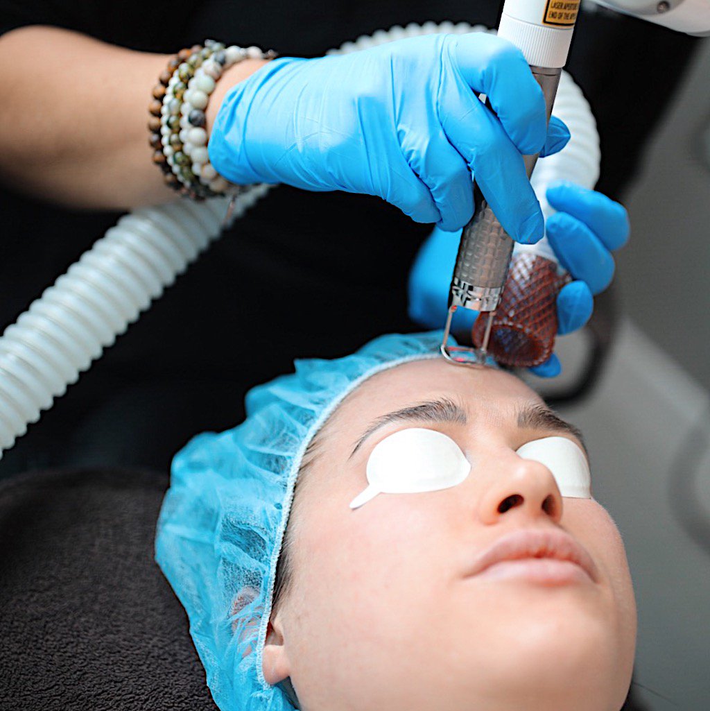 Midwest Laser Centre on Twitter "P E E L Away summers skin with Fotona