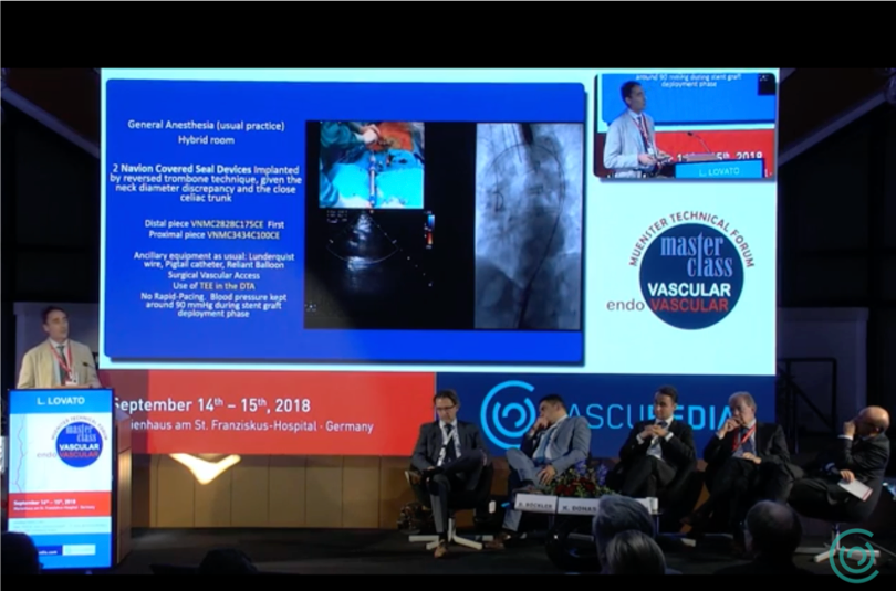 Vascupedia_com's tweet photo. Premiere at Vascupedia!
Check out the recorded case with the brand new low-profile Valiant Navion Medtronic thoracic endograft by Dr Lovato!
The upload of the unique Muenster Master Class has just begun!
https://t.co/LiUKRIMlsc
#Vascupedia #TEVARc #ValiantNavion #MasterClass2018 https://t.co/zOC8iCubIc