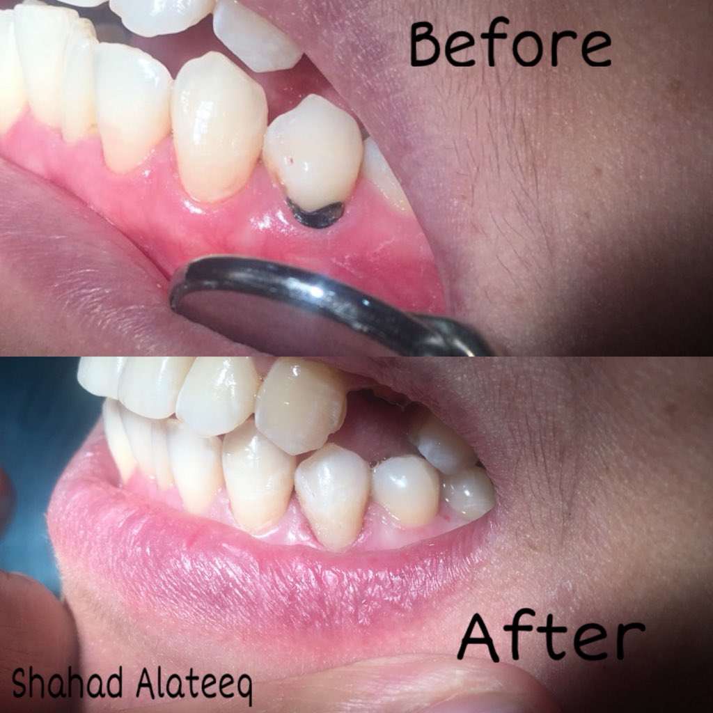 AlateeqShahd's tweet photo. Diagnosis in tooth No. #34=  cervical caries.
Treatment: class V composite  restoration, Filling the cavity by shade A3 
#REU
#جامعة_رياض_العلم https://t.co/B4O4pUIj2s
