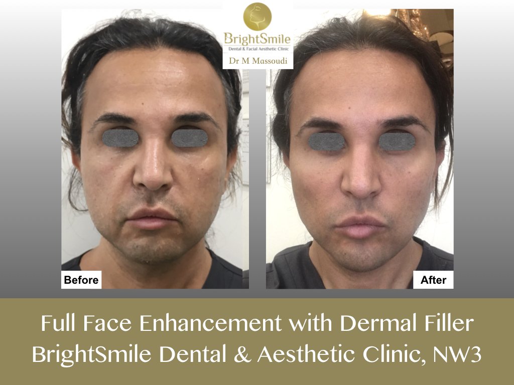 BrightSmileNW3's tweet photo. Non-Surgical Liquid Face Lift With Dermal Filler @BrightSmileNW3 https://t.co/WYQju7Lhg1 @TeoxaneUK #dermalfiller #botox #nonsurgical #facelift #liquidfacelift #londonNW3 #NW3 #teoxane https://t.co/L3uR2SJHOM