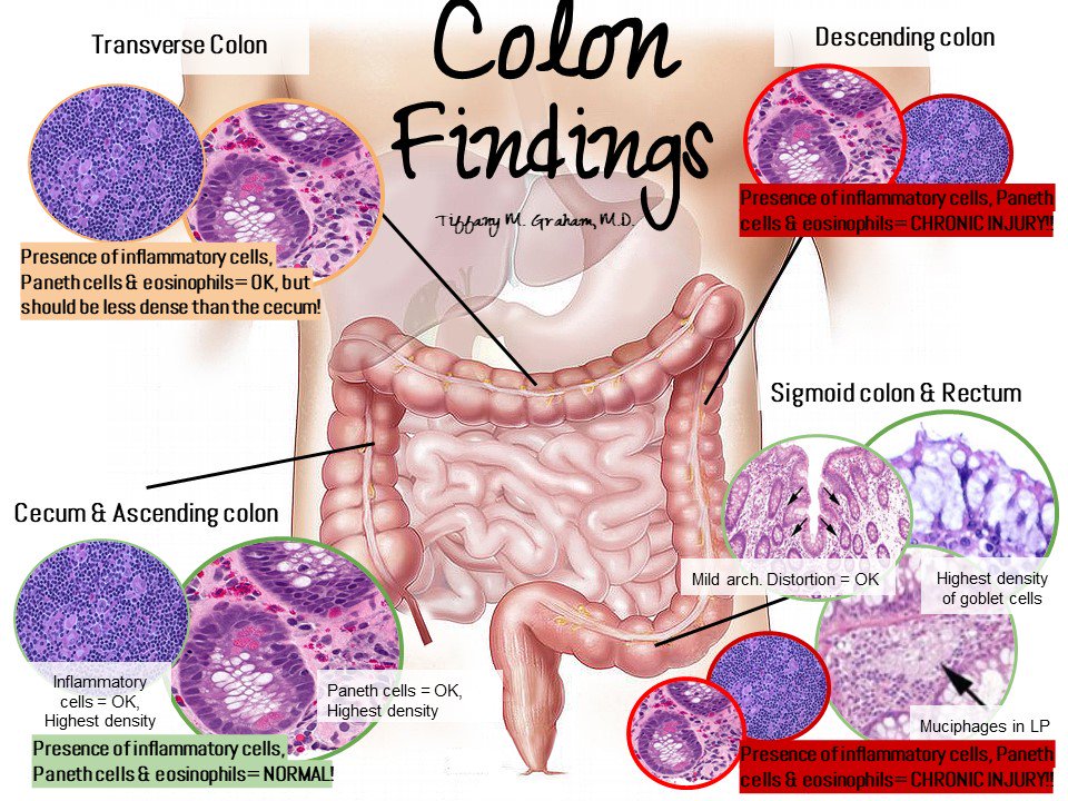 HeartPathology's tweet photo. FREE ADMISSION! A quick (histology) tour of the intestinal tract. Go take a gander at the full post(s)!
https://t.co/V1eHyjXQgx
#GIPath #PathforResidents #HighYieldPathology #Iheartpathology #PathTweetAward https://t.co/QopNt1g7PN