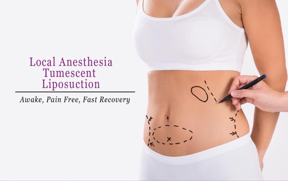 Dr. Khan offers a very specialized form of #Liposuction called #Tumescent Liposuction - totally by local anesthesia. This is a minimally invasive procedure with minimal downtime so you recover very fast &amp; are back to work within a few days! No general anesthesia hangover!