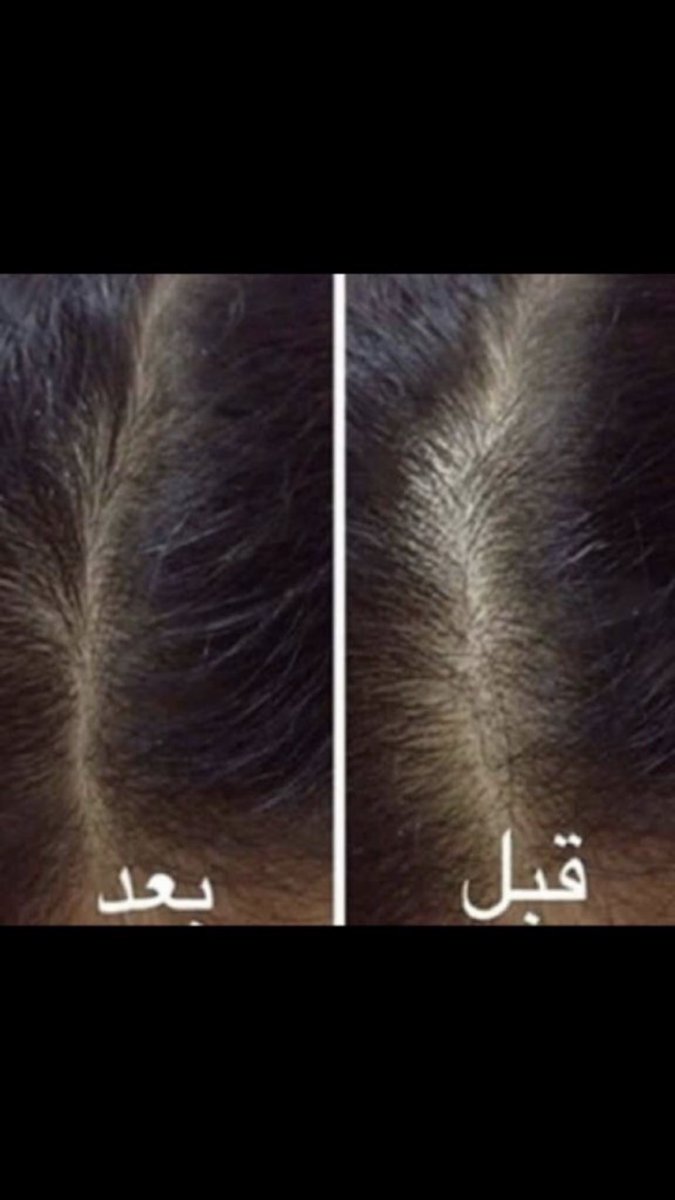 zithashish's tweet photo. زيت حشيش طبيعي وخام💯٪
علاج فعال
للفراغات
للصلع
للقشرة
للتساقط
يطول✔️
ينعم ويكثف
للدقن والشنب والرأس
 واتس 0546335844 https://t.co/keEDBljdKb