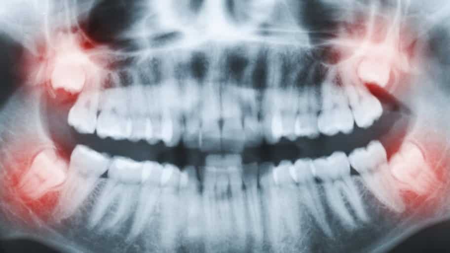 wisdomteeth_dr's tweet photo. If you need to take treatment of such issues or discover any manifestations identified with this, you can contact the #wisdomteethdentist. The Top Reasons regarding #wisdomtoothextraction.. https://t.co/xQMfXkPCJy https://t.co/ZOpUshZHtI