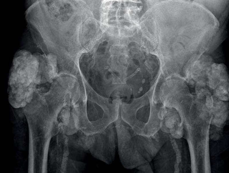 rheumatol123's tweet image. #Heterotopic #ossification: a challenging complication of total hip #arthroplasty risk factors, #diagnosis, #prophylaxis and #treatment
Know more: bit.ly/2DgFYOE