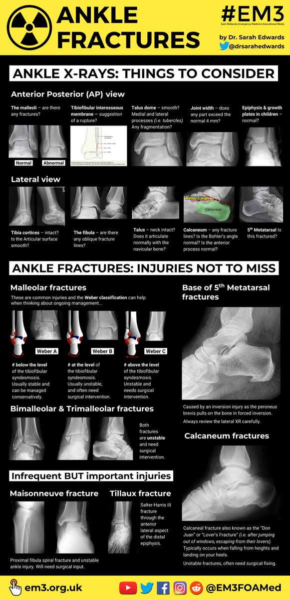 We finish off the week with another excellent #FOAMrad infographic by <a href="/drsarahedwards/">Dr Sarah Edwards</a> about the many different types of ankle fractures clinicians might encounter in the Emergency Department 👣🔬