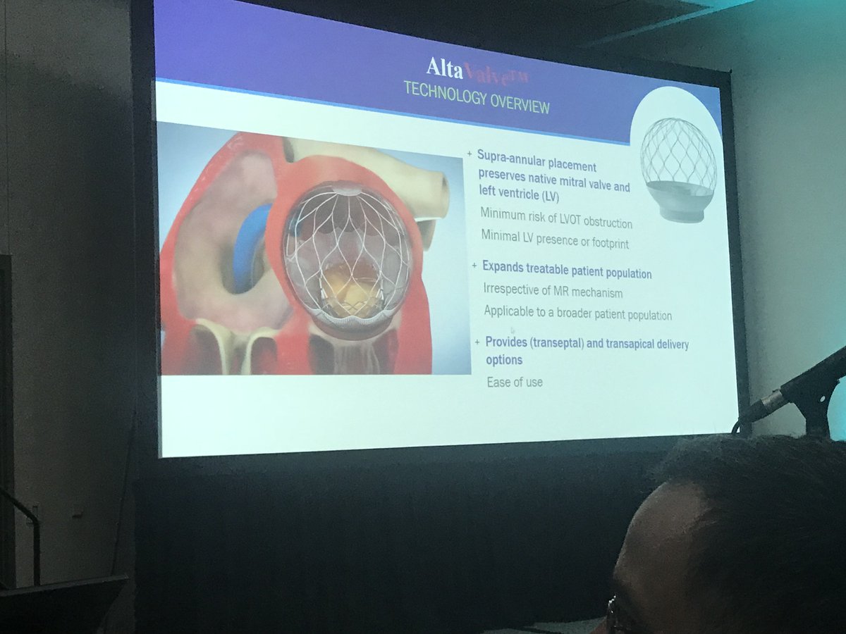 NishithChandra's tweet image. AltaValve,  a unique supraannular #TMVR approach. #TCT2018 #TCTConference @crfheart @willsuh76 @CMichaelGibson @chadialraies @SVRaoMD @ajaykirtane @mirvatalasnag @mmamas1973 @rajivxgulati @rahatheart1  @RajTayal2 @ShelleyWood2 @DrSheilaSahni @drjohnm @MartyMleon @GreggWStone