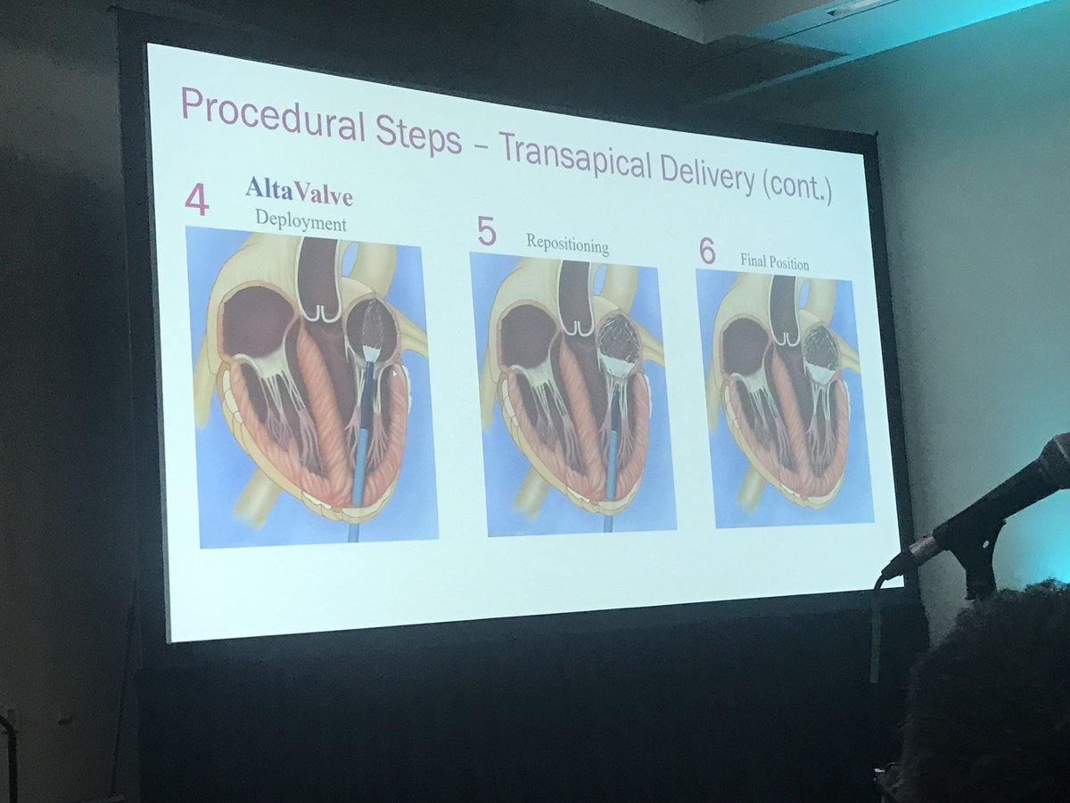 NishithChandra's tweet image. AltaValve,  a unique supraannular #TMVR approach. #TCT2018 #TCTConference @crfheart @willsuh76 @CMichaelGibson @chadialraies @SVRaoMD @ajaykirtane @mirvatalasnag @mmamas1973 @rajivxgulati @rahatheart1  @RajTayal2 @ShelleyWood2 @DrSheilaSahni @drjohnm @MartyMleon @GreggWStone