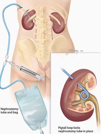 As part of #urologyawareness month I’d like to highlight the issues many patients with a #nephrostomy have: No follow up care, no advice re supplies, huge variation in advice across the NHS. Many patients have to resort to online support groups & get advise from fellow patients