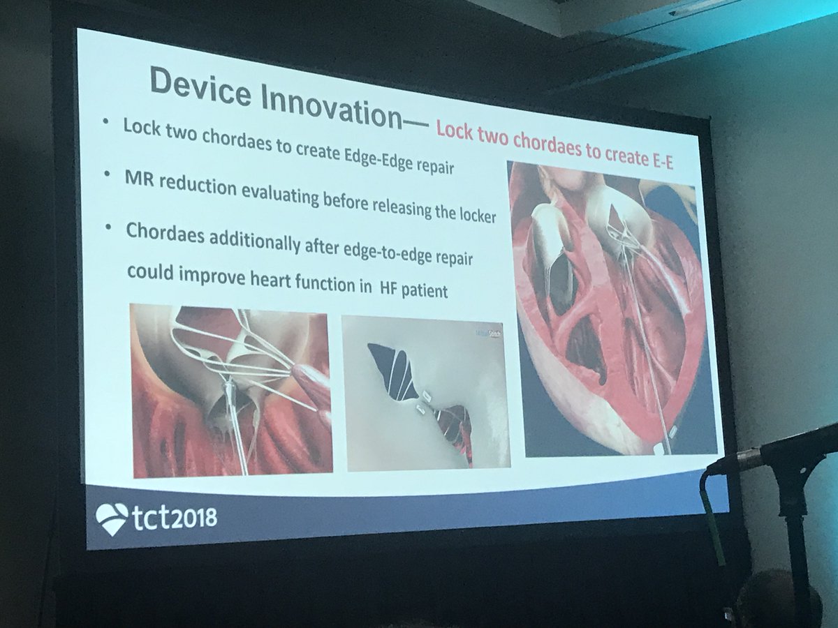 NishithChandra's tweet image. Move over #mitraclip, you have a competition.  In comes “ MitralStitch” which replaces chordaes as well as clips mitral leaflets in a single device.  #TCTConference #TCT2018 @TCTMD @crfheart @ShelleyWood2 @SVRaoMD @ajaykirtane @mirvatalasnag @CMichaelGibson @willsuh76 @EricTopol