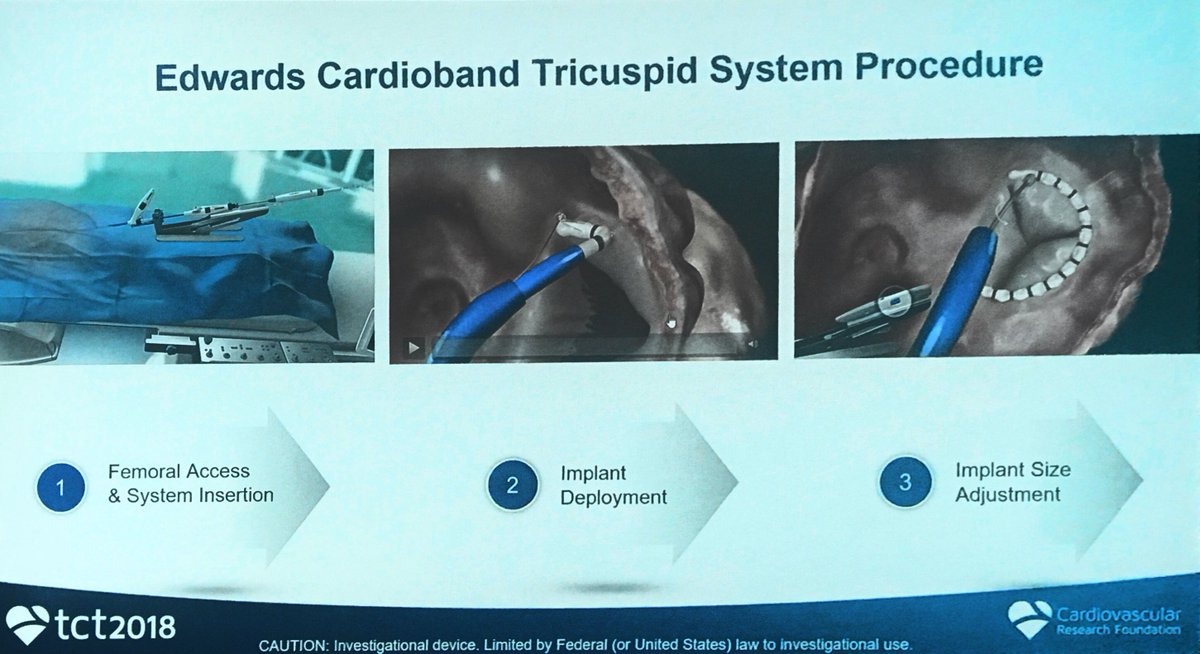 NishithChandra's tweet image. Edwards Cardioband Tricuspid valve system. @crfheart #TCTConference #tct2018 @SVRaoMD @DrPascalMeier @mirvatalasnag @drjohnm @escardio @PCRonline @ekgpdx