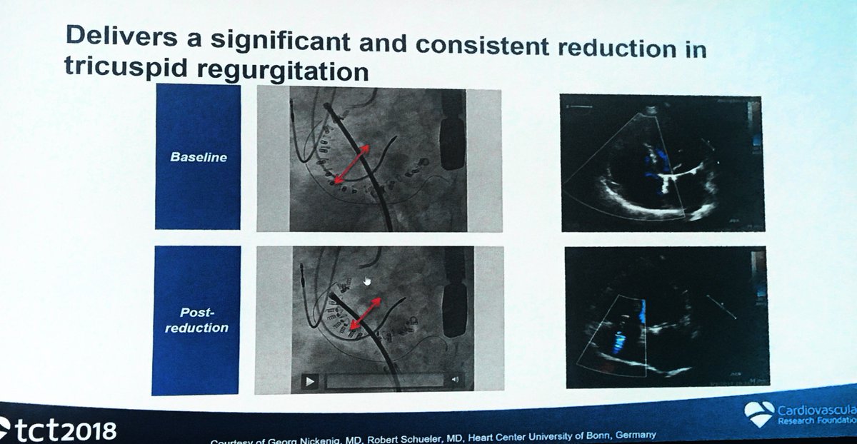NishithChandra's tweet image. Edwards Cardioband Tricuspid valve system. @crfheart #TCTConference #tct2018 @SVRaoMD @DrPascalMeier @mirvatalasnag @drjohnm @escardio @PCRonline @ekgpdx