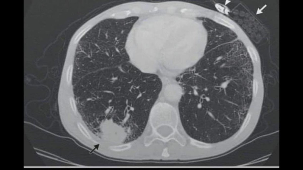 doctormacias's tweet photo. Fiel hasta la muerte. La flecha negra abajo muestra un cáncer del pulmón con destrucción de las costillas. La flecha blanca arriba muestra que el paciente mantuvo en la bata los cigarrillos y el encendedor. Murió poco después (NEJM,2018). https://t.co/JfZm1xmeui