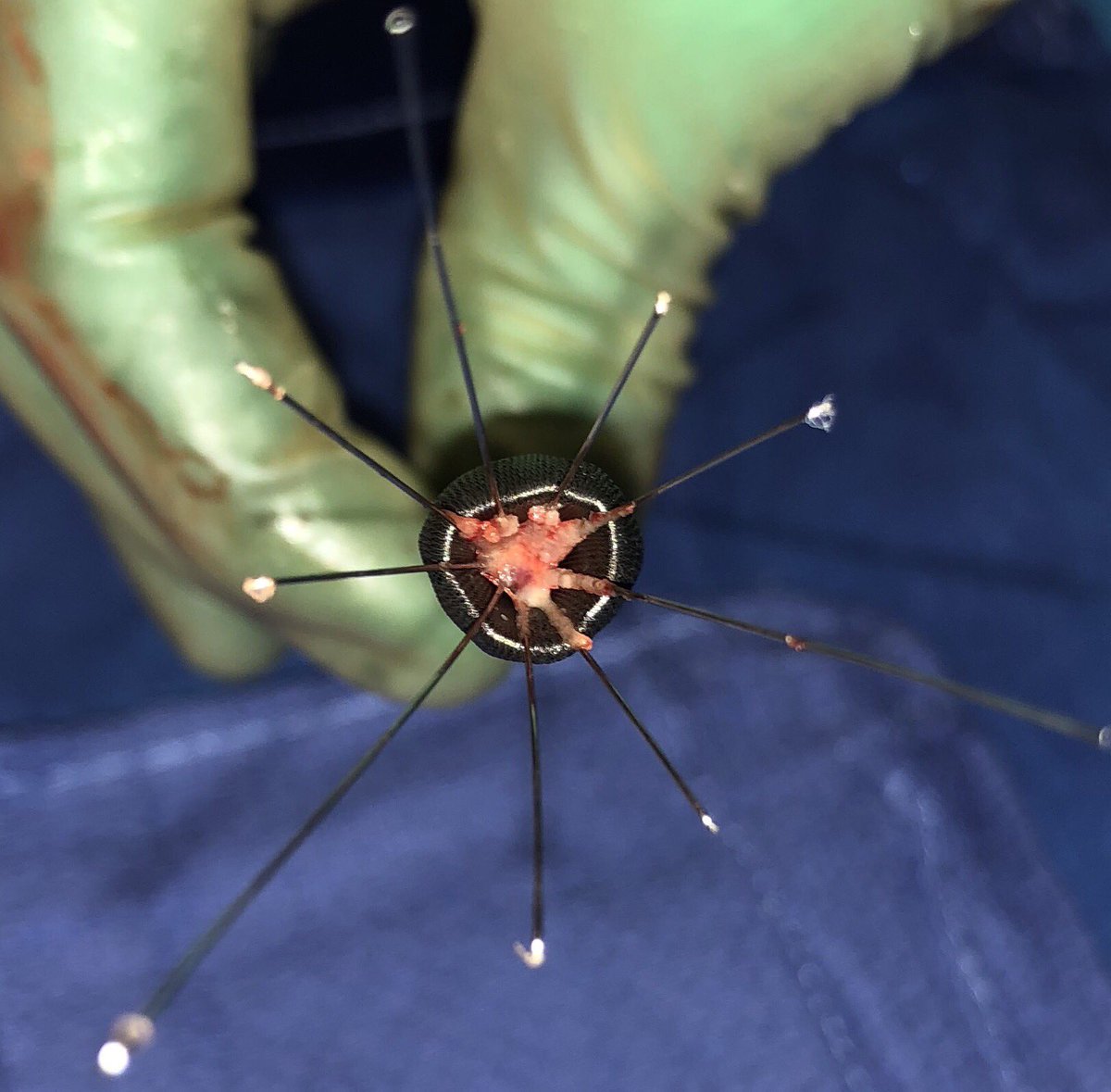 UCD_IR's tweet image. #Captus strikes again. #filterout in minutes. ALN with apical fibrin just 3 months after implantation. #iRad @ScottAU22 @rkryu @kush_r_desai
