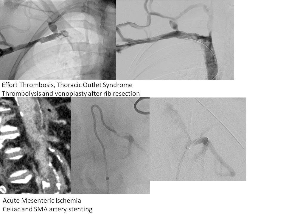 AzeneMD's tweet image. IR’s do everything. Provide tremendous value to their practices, hospitals, and healthcare. No other procedural specialty can provide the same depth and breadth as IR. This is only half of the procedures performed by 1 IR in 1 day on 9/20; and it’s routine. @SIRspecialists #IRad