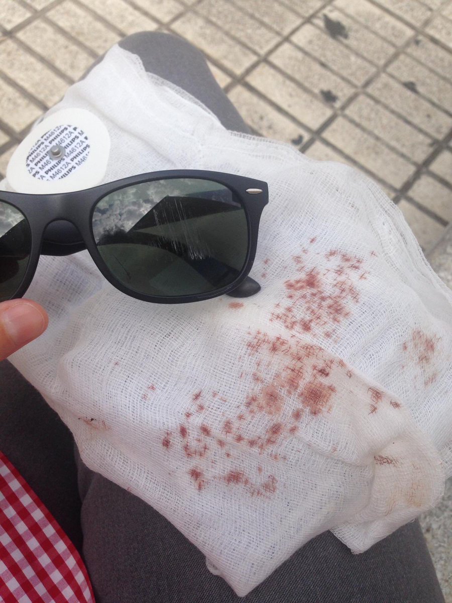 jorgemorata's tweet photo. Mi padre quedó así al tropezarse con una manguera en unas obras sin señalizar. En serio @Mercadona no vais a pagarle ni los dientes ni las gafas?! No pide indemnizaciones, solo que no mintáis más en el juicio! Que además del mal rato le ha costado dinero. #NoVuelvoaMercadona https://t.co/zchyw3jm53