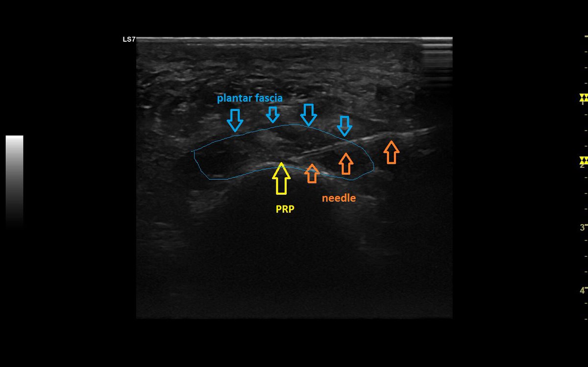 Ultrasound guided PRP injection of the plantar fascia needs a good guidance and can be very painful due to the small infiltration space and tight fibers... #plantarfasciitis #ultrasoundguidedinjection #prp #prptherapy #mskus #pocus #pointofcareultrasound