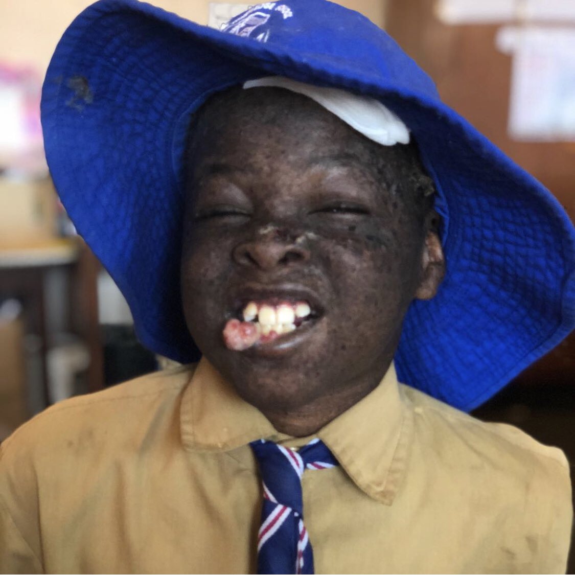 minimithiko's tweet photo. I met a handsome angel named โProsperโ he is suffering from Xeroderma pigmentosum. Help me help him fulfill his dreams... PM me how... he is scheduled for an operation tomorrow. #Prosper #XerodermaPigmentosum #Love #Angel #FlyHighDragonfly #Help #Harare #Zimbabwe #Doctors https://t.co/jF9TwpivkM