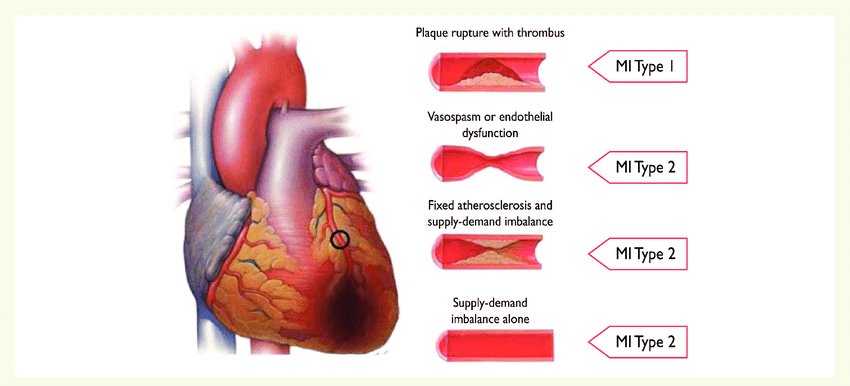 cardiologists18's tweet photo. Myocardial infarction affects close to 1.5 million people in North America each year. 
 https://t.co/JVWDEDosf2

#Cardiologists2018 #CardiologistsConference #CardiologyCongress

@KardioStar @QuinaCatarina @NeilFlochMD @JamiLeaf  @DrLindaMD @IQuitSmoking_1 https://t.co/I2rp0PEWjL