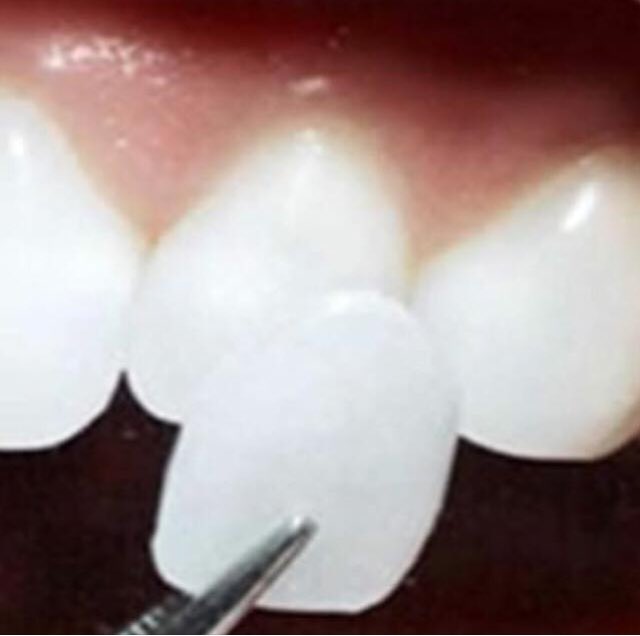 timplantedental's tweet photo. ¿#SabiasQue puedes mejorar tu #Sonrisa con las Carillas #Dentales?... Conócelas aquí  ►  https://t.co/nPNjuieeKA
_______
#Sonrisa #Smile #Odontologia #ProtesisDental #Protesis #CambiamosVidas #Salud https://t.co/1FJr6ruyil