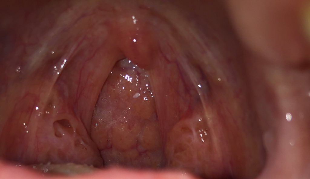 Tonsil bengkak