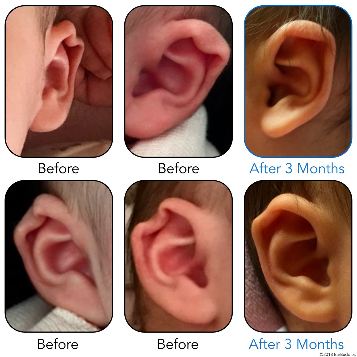 EarBuddies's tweet photo. This Mum permanently corrected her Daughter's #Ears with #EarBuddies π Follow the link to read her full story: https://t.co/eiZRGvM5d5 #babies #medicaldevice #beforeandafter #newborn #parents #parenthood #parenting #Pediatrician #pregnant #midwife #parentingtips #eardeformity https://t.co/ZIzXBqjVTm