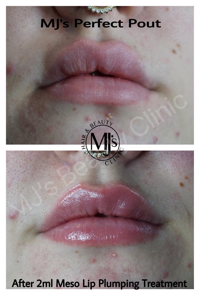 MJsBeautyClinic's tweet photo. 💋💉MJ's Perfect Pout by Mel💉💋
Available now at an introductory offer only £50!
Contact Mel, Meso Specialist for more information: 07955 782378
#Royton #mjsbeautyclinic #manchester #mjsperfectpout #beforeandafter #lipplumping #mesotherapy #nappage #hydration #meso https://t.co/KKWaM27meS