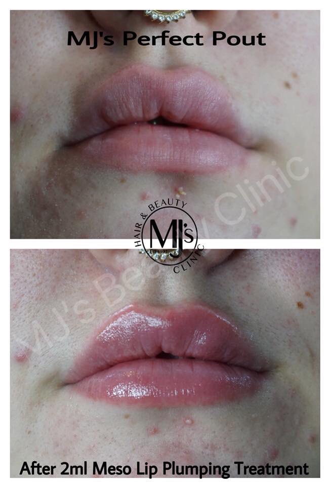 💋💉MJ's Perfect Pout by Mel💉💋
Available now at an introductory offer only £50! 

Contact Mel, Meso Specialist for more information: 07955 782378 
#Royton #mjsbeautyclinic #manchester #mjsperfectpout #beforeandafter #lipplumping #mesotherapy #nappage #hydration #meso