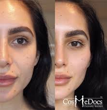 PlasticMeet's tweet photo. #Call_for_Abstract. #Submit your #Abstract on different #Tracks #Cheek_Augmentation
#Reconstructive_surgery #Abdominoplasty #Rhinoplasty #Burn_Surgery
#Skin_rejuvenation #Blepharoplasty #Mammoplasty
#Plastic_Surgery2019
For #more details ……https://t.co/7SVSPJhOba https://t.co/QKRlRlNtaz
