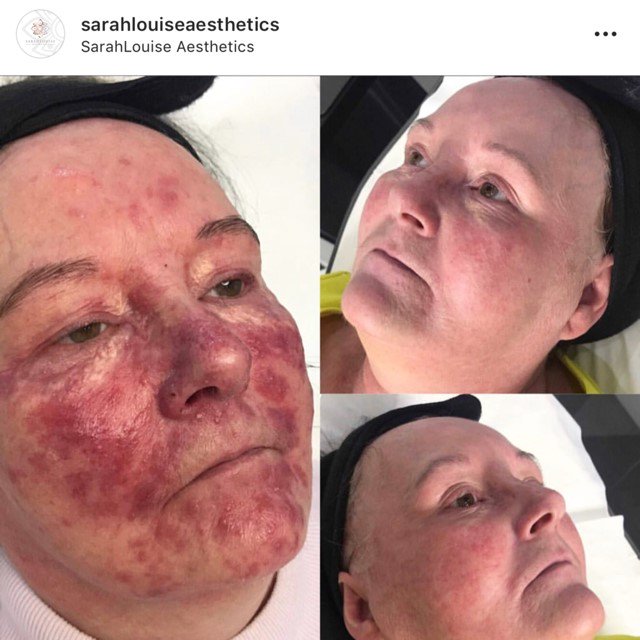 Amazing results by @sarahlouiseaesthetics Her client Hazel did 10 weeks of an intensive treatment which included AlumierMD chemical peels and home care. #alumiermd #peelseason #chemicalpeel #glowingskin #skincareprofessional #professionalresults #realresults