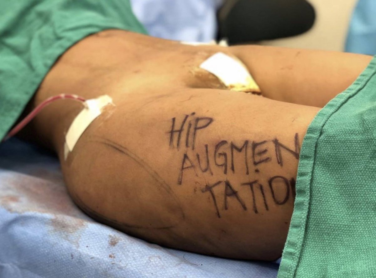 VisageClinic's tweet photo. Interested in #HipAugmentation? Visage Clinic's Dr. DuPéré is Canada's premier plastic surgeon - learn more, see Before/After photos and book your consultation at https://t.co/gYNrW03TsH or by calling (416) 929-9800!✨ #VisageClinic https://t.co/vS6wbt3iUr