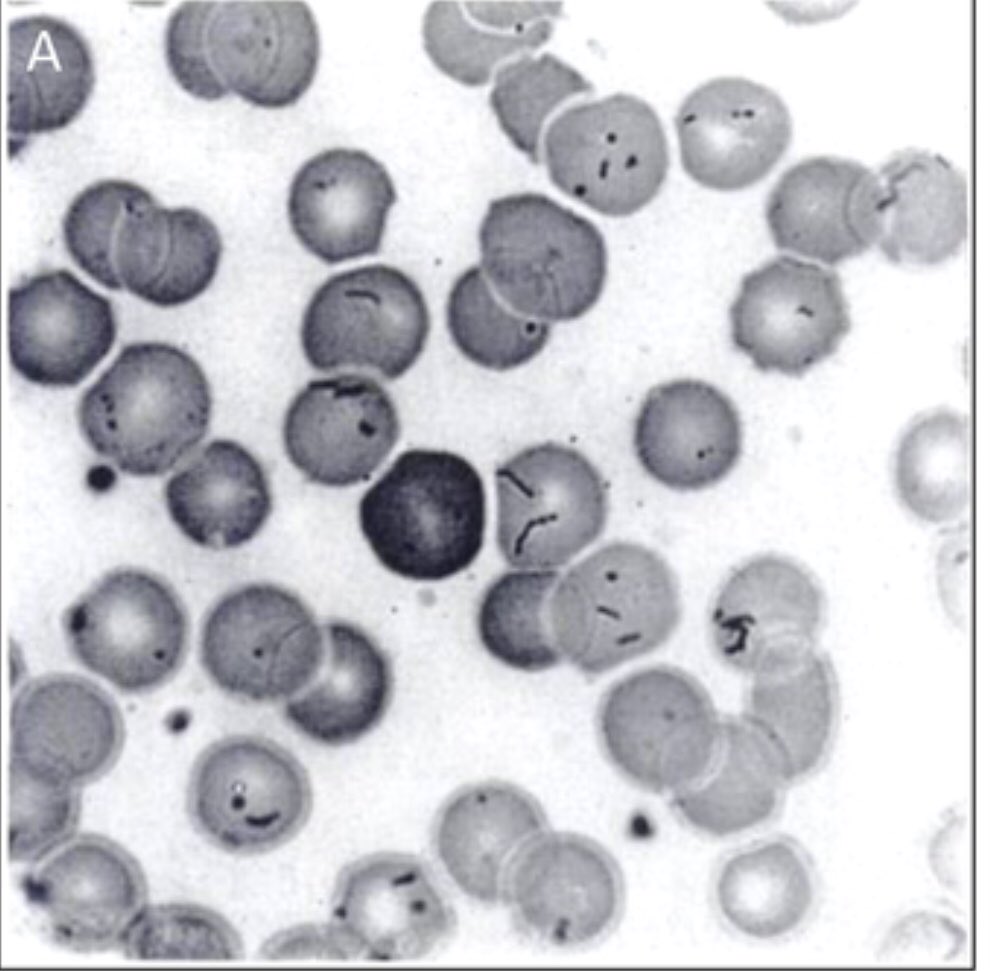 WuidQ's tweet photo. (1/2) 30/M w fever, confusion, jaundice. Fever 5d ago w myalgia. 1d prior, +AMS/jaundice. Returned 3 wks ago fr the Andes mountains in Peru, took Malarone, +vaccines, had +arthropod bites. WBC 8, Hgb 4.5, plt 180. ALT 68, TB 6 (0.8 direct), haptoglob <30. Blood smear shown: https://t.co/zSTAwVZh5a