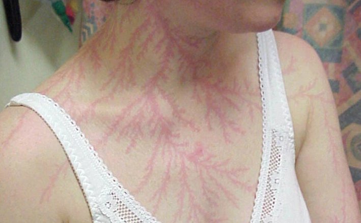 lightning scars name lightning scars name