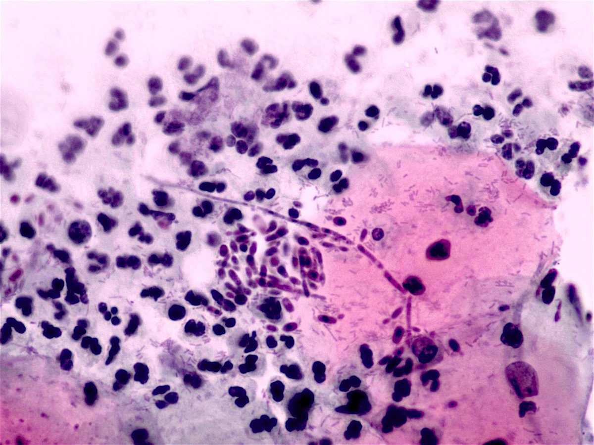 File:Aspergilloma (5390379559).jpg - Wikimedia Commons