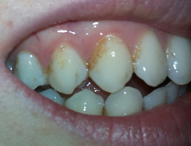 zazoomnews's tweet image. “Mai più macchie”. Come evitare gli aloni sui denti e avere un sorriso perfetto - #macchie”. #evitare #aloni #denti zazoom.info/ultime-news/47…