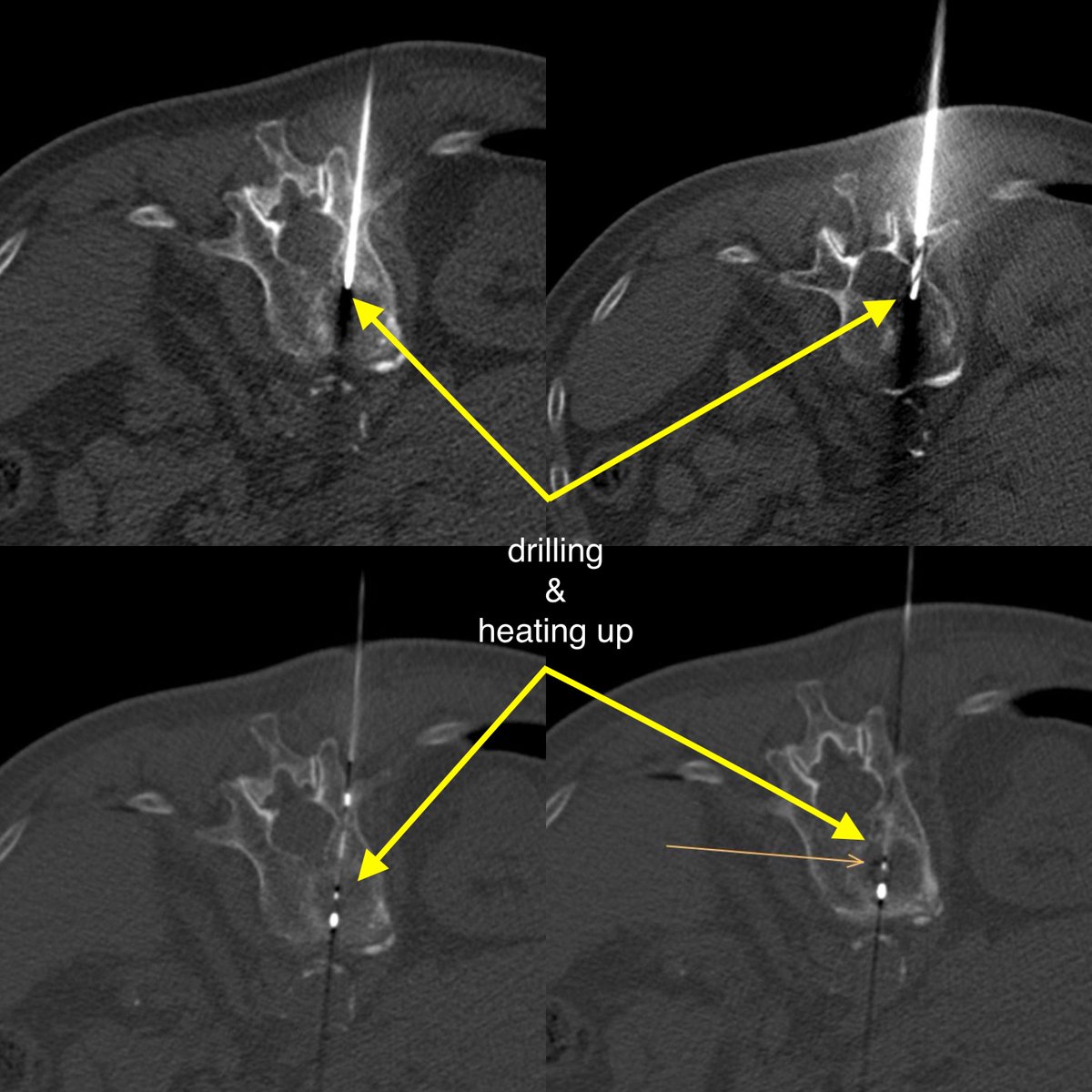 TobiasJakobs's tweet photo. Microwave ablation followed by cementoplasty in a painful vertebral metastasis from CRC - quick and precise procedure with complete pain relief the day after! Great success for the patient. #IRad #minimalinasive #withoutascalpel @SiemensHealthineers #CTguided https://t.co/67TR6pdeZ9