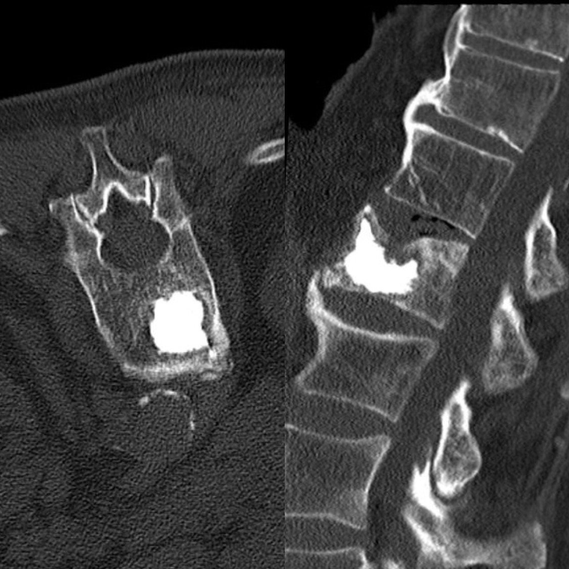 TobiasJakobs's tweet photo. Microwave ablation followed by cementoplasty in a painful vertebral metastasis from CRC - quick and precise procedure with complete pain relief the day after! Great success for the patient. #IRad #minimalinasive #withoutascalpel @SiemensHealthineers #CTguided https://t.co/67TR6pdeZ9