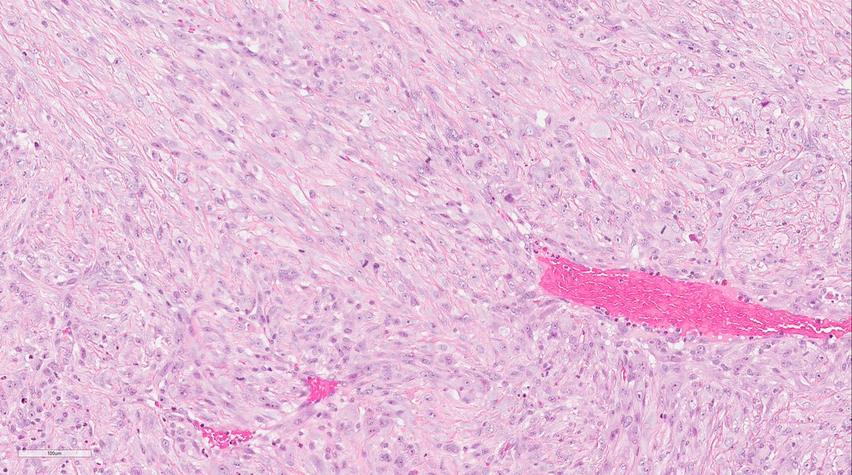 Bin Xu on Twitter "7 Heterologous component may be seen in a small percentage of cases either